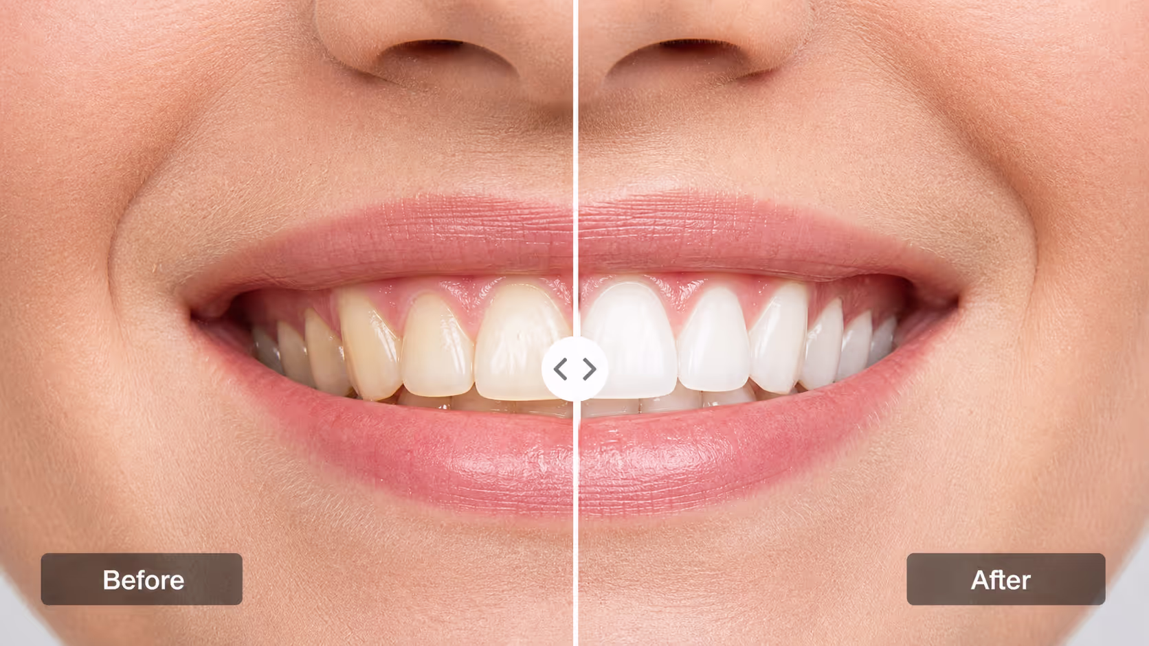 Teeth whitening