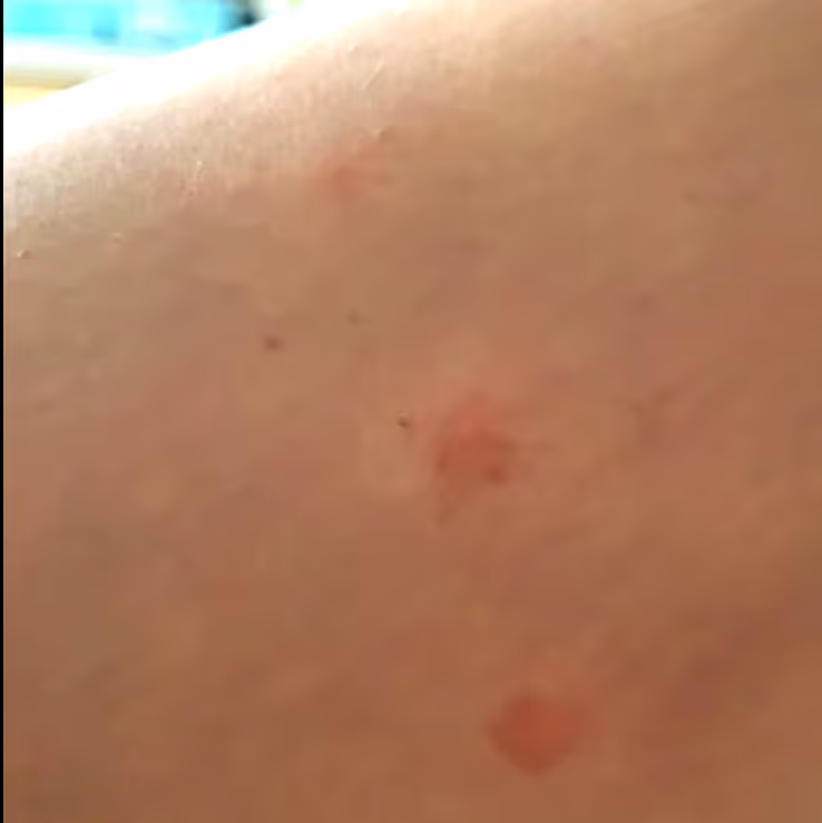 flee bites during one of our sits