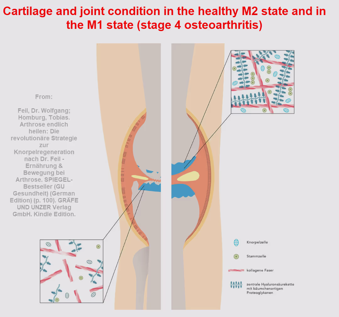 Picture of Cartilage and joint condition in the healthy M2 state and in the M1 state (stage 4 osteoarthritis)